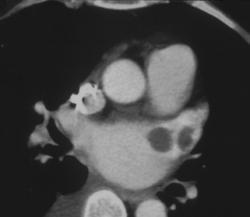 Clots in Left Atrium - CTisus CT Scan