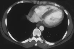 Cardiac Sarcoid in the Intraventricular Septum - CTisus CT Scan