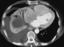 Amyloid Infiltrates the Heart - CTisus CT Scan