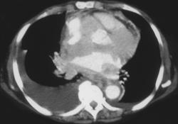 Rhabdomyosarcoma Infiltrating the Heart - CTisus CT Scan