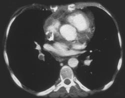 Pulmonary Embolism - CTisus CT Scan