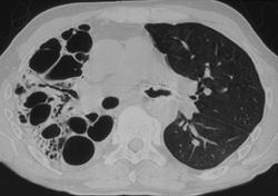 Bronchiectasis - CTisus CT Scan