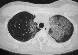 Radiation Pneumonitis - CTisus CT Scan