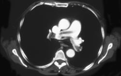 Pulmonary Embolism - CTisus CT Scan