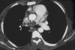 Pulmonary Embolism - CTisus CT Scan