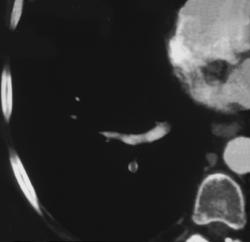 Pulmonary Embolism - CTisus CT Scan