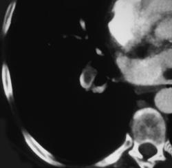 Pulmonary Embolism - CTisus CT Scan