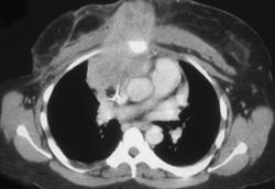 Recurrent Breast Cancer - CTisus CT Scan