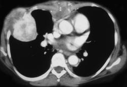 Neuroendocrine Tumor of the Pancreas (vascular) With Chest Wall Metastases - CTisus CT Scan