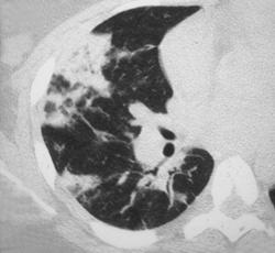 Pulmonary Infarcts - CTisus CT Scan