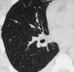 Bronchiolitis Obliterans Organizing Pneumonia (BOOP) in Bone Marrow Transplant Patient - CTisus CT Scan