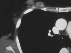 Breast Cancer (subcutaneous Nodules) - CTisus CT Scan