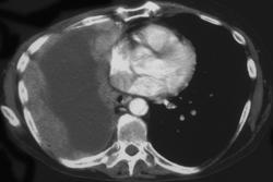 Adenocarcinoma Metastatic to the Pleura - CTisus CT Scan