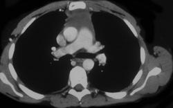 Primary Germ Cell Tumor - CTisus CT Scan