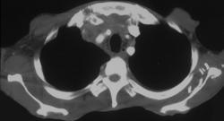 Jugular Vein Thrombosis - CTisus CT Scan