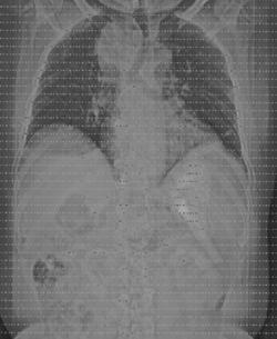 Substernal Thyroid - CTisus CT Scan