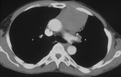 Primary Small Cell Tumor of the Mediastinum - CTisus CT Scan