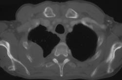 Lung Cancer With Renal Metastases - CTisus CT Scan