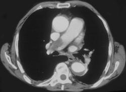 Pulmonary Embolism - CTisus CT Scan