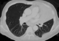 Left Upper Lobe Collapse - CTisus CT Scan