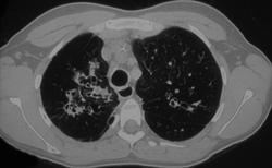 Bronchiectasis - CTisus CT Scan