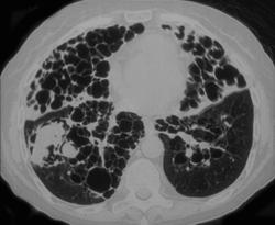 Bronchiectasis - CTisus CT Scan