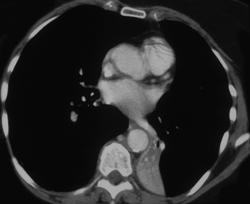 Left Lower Lobe Atelectasis - CTisus CT Scan