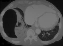 Broncho-pleural Fistulae - CTisus CT Scan