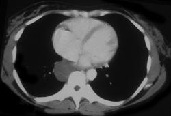 Bronchogenic Cyst - CTisus CT Scan