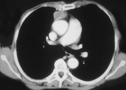 Thymoma - CTisus CT Scan