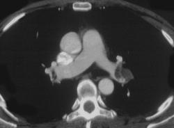 Pulmonary Embolism - CTisus CT Scan