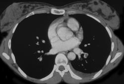 Pulmonary Embolism - CTisus CT Scan