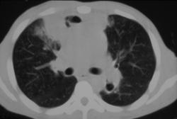 Mediastinal Abscess - CTisus CT Scan