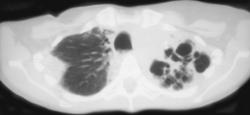 Radiation Fibrosis - CTisus CT Scan