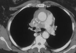 Fibrosing Mediastinitis With SVC Syndrome - CTisus CT Scan