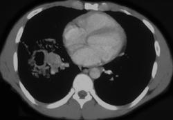 Cavitary Lung Cancer - CTisus CT Scan