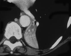 Left Lower Lobe Atelectasis - CTisus CT Scan