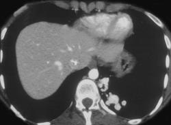 Pulmonary Arteriovenous Malformation (PAVM) - CTisus CT Scan