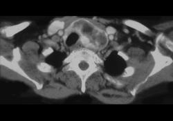 Substernal Thyroid - CTisus CT Scan