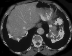 Plaques on the Diaphragm - CTisus CT Scan