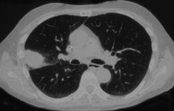 Invasive Pulmonary Aspergillosis (IPA) - CTisus CT Scan