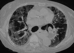 Scleroderma - CTisus CT Scan