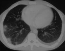 Pulmonary Embolism - CTisus CT Scan