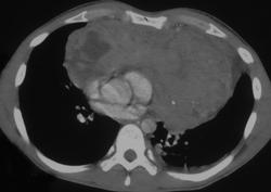 Lymphoma - CTisus CT Scan