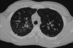 Cystic Fibrosis - CTisus CT Scan