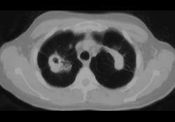 Conglomerate Masses- Silicosis - CTisus CT Scan