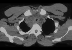 Primary Tracheal Cancer With Nodes - CTisus CT Scan