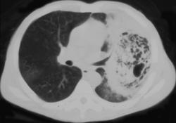 Pulmonary Gangrene - CTisus CT Scan