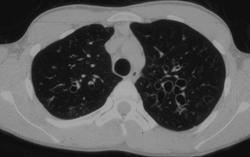 Cystic Fibrosis (mild) - CTisus CT Scan