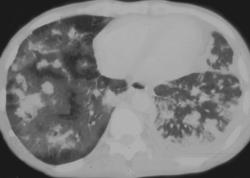 Kaposis Sarcoma - CTisus CT Scan